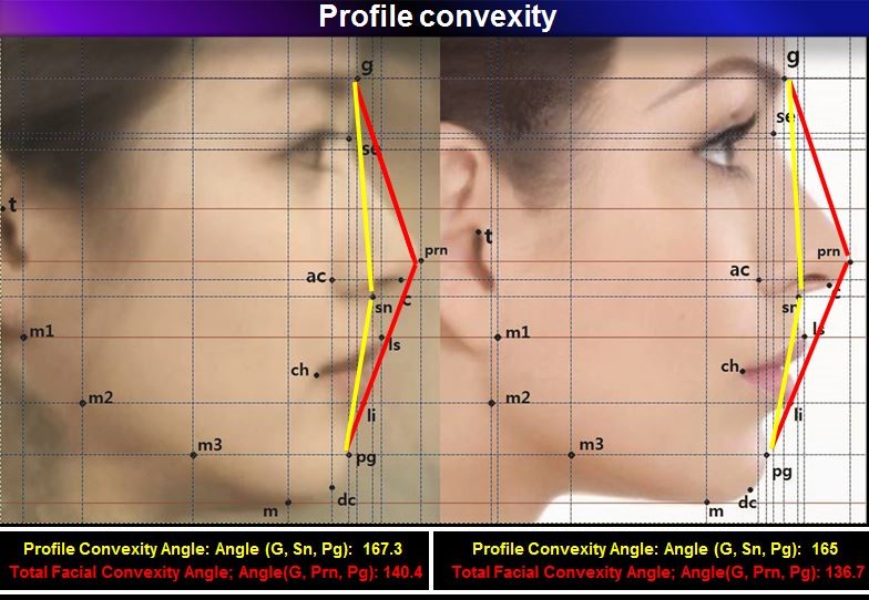 33. Facial Profile Analysis D&PS